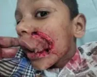 शहागडमध्ये मोकाट कुत्र्यांचा थरार; ११ वर्षीय चिमुकल्यावर जीवघेणा हल्ला